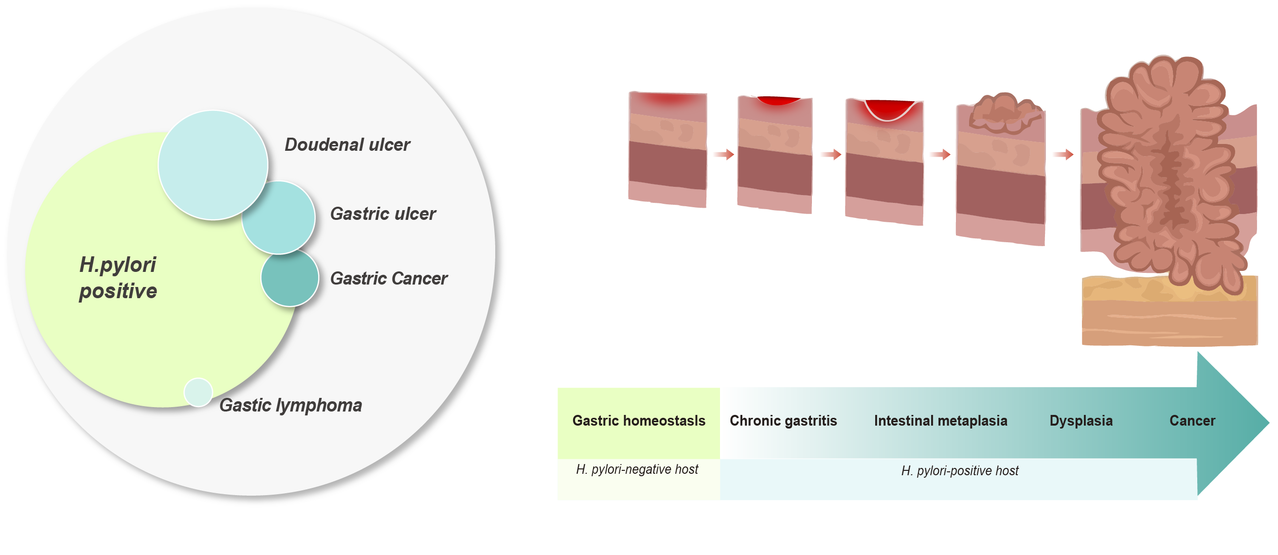 The process and ratio of H. pylori infection developing into cancer or other diseases - UltraPeace/UltraE